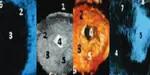 Morphological and radiological study of lymph nodes in dromedaries in Algeria